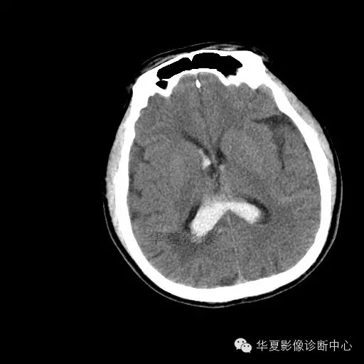 【病例学习】烟雾病一例影像诊断 【病例学习】烟雾病一例影像诊断