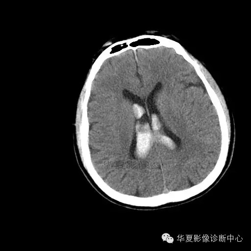 【病例学习】烟雾病一例影像诊断 【病例学习】烟雾病一例影像诊断