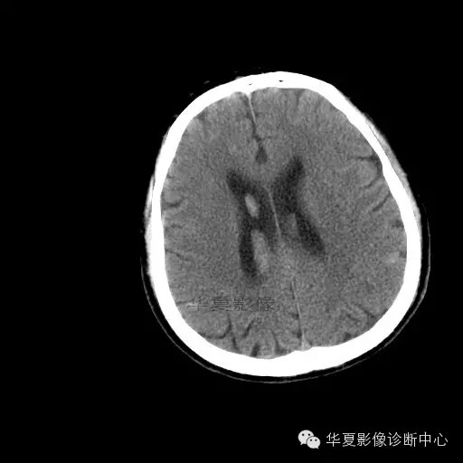 【病例学习】烟雾病一例影像诊断 【病例学习】烟雾病一例影像诊断