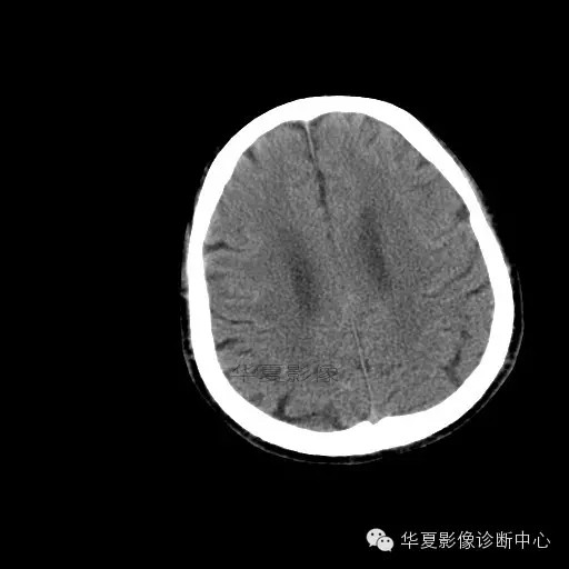 【病例学习】烟雾病一例影像诊断 【病例学习】烟雾病一例影像诊断