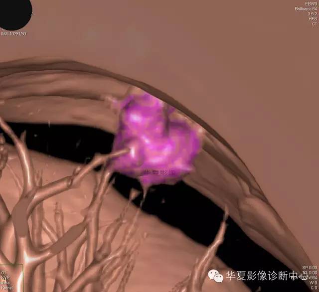 【病例学习】 【病例学习】