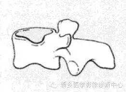 【一句话学影像】一组图让您——从椎体形态“顿悟”椎体疾病 【一句话学影像】一组图让您——从椎体形态“顿悟”椎体疾病