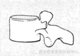 【一句话学影像】一组图让您——从椎体形态“顿悟”椎体疾病 【一句话学影像】一组图让您——从椎体形态“顿悟”椎体疾病