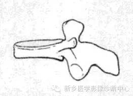 【一句话学影像】一组图让您——从椎体形态“顿悟”椎体疾病 【一句话学影像】一组图让您——从椎体形态“顿悟”椎体疾病