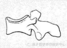 【一句话学影像】一组图让您——从椎体形态“顿悟”椎体疾病 【一句话学影像】一组图让您——从椎体形态“顿悟”椎体疾病