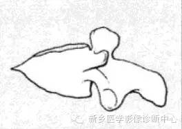 【一句话学影像】一组图让您——从椎体形态“顿悟”椎体疾病 【一句话学影像】一组图让您——从椎体形态“顿悟”椎体疾病