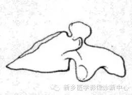 【一句话学影像】一组图让您——从椎体形态“顿悟”椎体疾病 【一句话学影像】一组图让您——从椎体形态“顿悟”椎体疾病