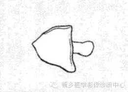 【一句话学影像】一组图让您——从椎体形态“顿悟”椎体疾病 【一句话学影像】一组图让您——从椎体形态“顿悟”椎体疾病