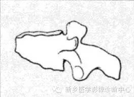 【一句话学影像】一组图让您——从椎体形态“顿悟”椎体疾病 【一句话学影像】一组图让您——从椎体形态“顿悟”椎体疾病