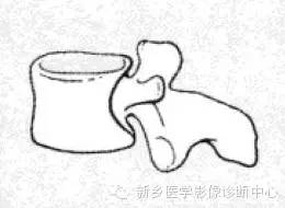 【一句话学影像】一组图让您——从椎体形态“顿悟”椎体疾病 【一句话学影像】一组图让您——从椎体形态“顿悟”椎体疾病