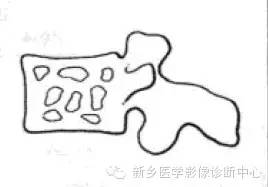 【一句话学影像】一组图让您——从椎体形态“顿悟”椎体疾病 【一句话学影像】一组图让您——从椎体形态“顿悟”椎体疾病