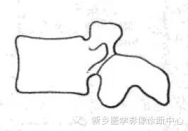 【一句话学影像】一组图让您——从椎体形态“顿悟”椎体疾病 【一句话学影像】一组图让您——从椎体形态“顿悟”椎体疾病