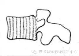 【一句话学影像】一组图让您——从椎体形态“顿悟”椎体疾病 【一句话学影像】一组图让您——从椎体形态“顿悟”椎体疾病