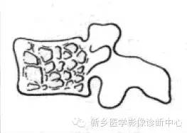 【一句话学影像】一组图让您——从椎体形态“顿悟”椎体疾病 【一句话学影像】一组图让您——从椎体形态“顿悟”椎体疾病