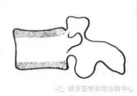 【一句话学影像】一组图让您——从椎体形态“顿悟”椎体疾病 【一句话学影像】一组图让您——从椎体形态“顿悟”椎体疾病