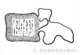 【一句话学影像】一组图让您——从椎体形态“顿悟”椎体疾病 【一句话学影像】一组图让您——从椎体形态“顿悟”椎体疾病