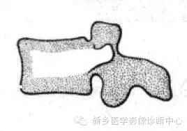 【一句话学影像】一组图让您——从椎体形态“顿悟”椎体疾病 【一句话学影像】一组图让您——从椎体形态“顿悟”椎体疾病