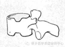 【一句话学影像】一组图让您——从椎体形态“顿悟”椎体疾病 【一句话学影像】一组图让您——从椎体形态“顿悟”椎体疾病