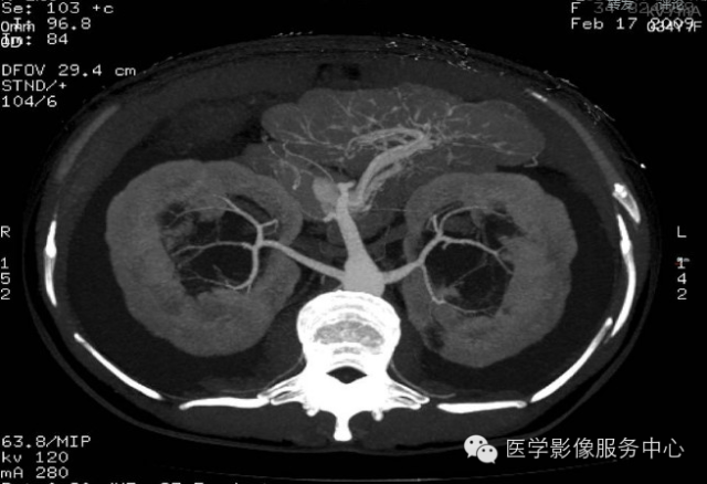 【罕见但过目不忘】双肾囊性淋巴管瘤一例影像学表现 【罕见但过目不忘】双肾囊性淋巴管瘤一例影像学表现