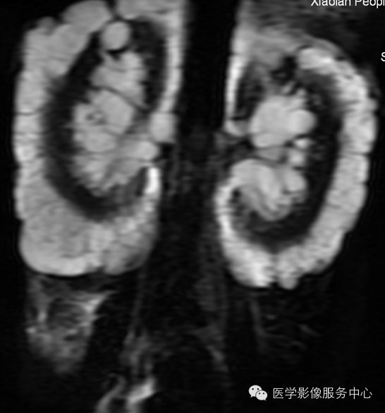 【罕见但过目不忘】双肾囊性淋巴管瘤一例影像学表现 【罕见但过目不忘】双肾囊性淋巴管瘤一例影像学表现