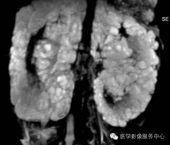 【罕见但过目不忘】双肾囊性淋巴管瘤一例影像学表现 【罕见但过目不忘】双肾囊性淋巴管瘤一例影像学表现
