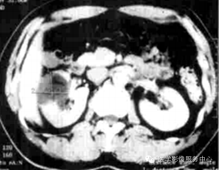 【罕见但过目不忘】双肾囊性淋巴管瘤一例影像学表现 【罕见但过目不忘】双肾囊性淋巴管瘤一例影像学表现