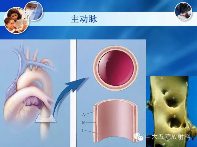 主动脉病变病理基础和影像表现