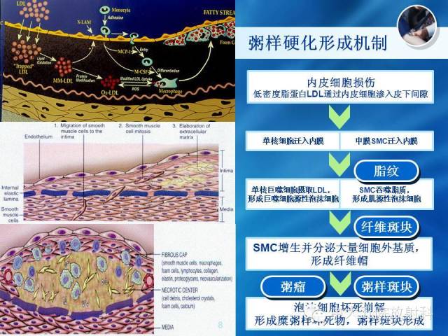 主动脉病变病理基础和影像表现
