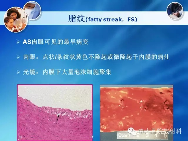 主动脉病变病理基础和影像表现