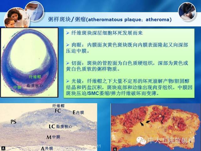 主动脉病变病理基础和影像表现