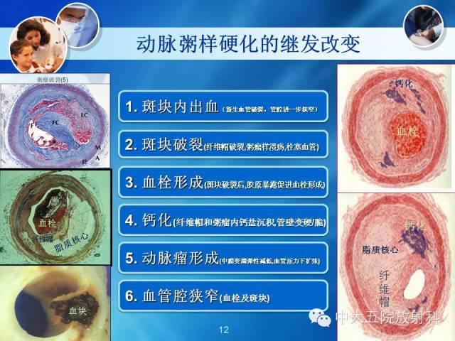 主动脉病变病理基础和影像表现