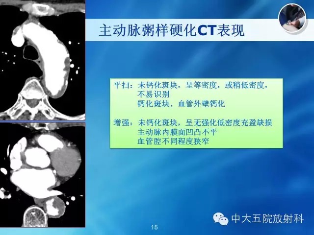 主动脉病变病理基础和影像表现