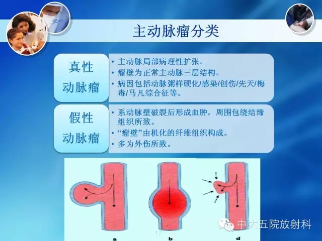 主动脉病变病理基础和影像表现