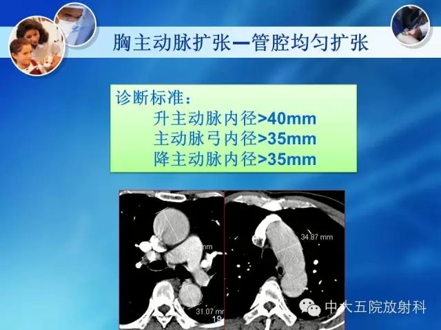 主动脉病变病理基础和影像表现