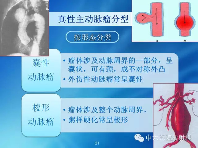 主动脉病变病理基础和影像表现