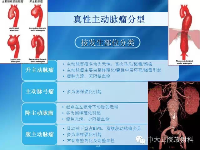 主动脉病变病理基础和影像表现