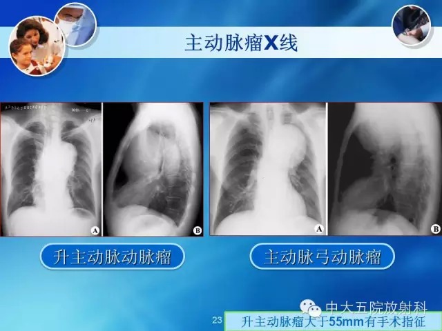 主动脉病变病理基础和影像表现