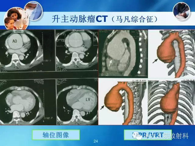 主动脉病变病理基础和影像表现