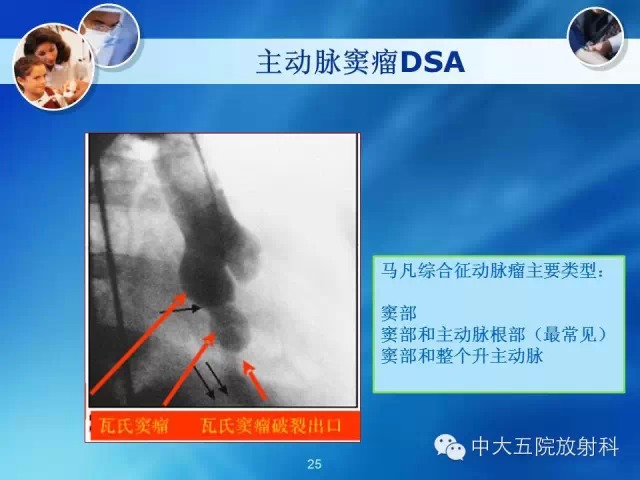 主动脉病变病理基础和影像表现