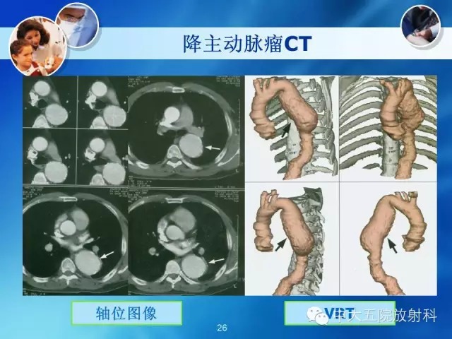 主动脉病变病理基础和影像表现