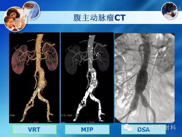 主动脉病变病理基础和影像表现