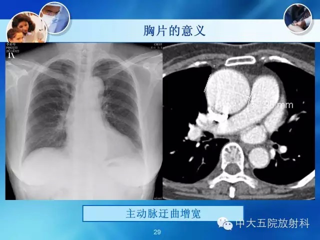 主动脉病变病理基础和影像表现