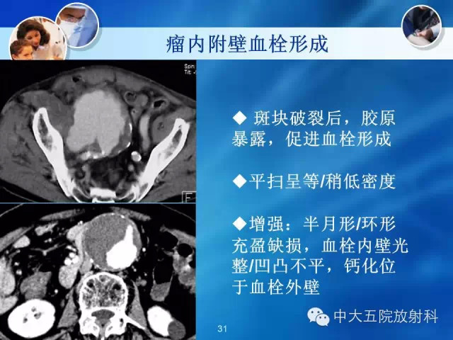 主动脉病变病理基础和影像表现