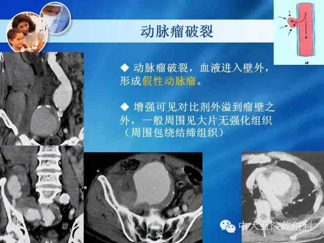 主动脉病变病理基础和影像表现