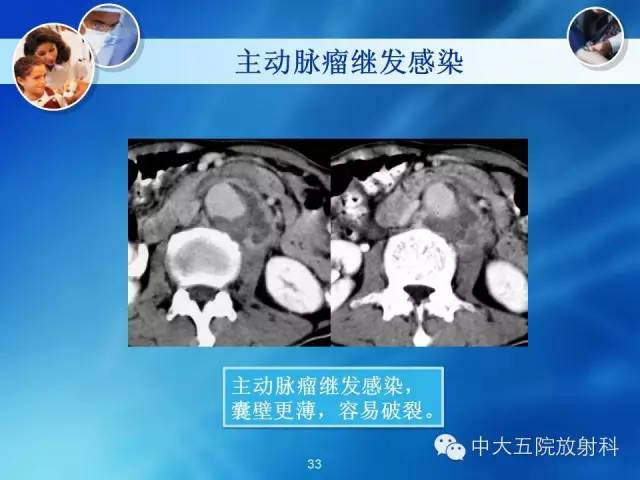 主动脉病变病理基础和影像表现