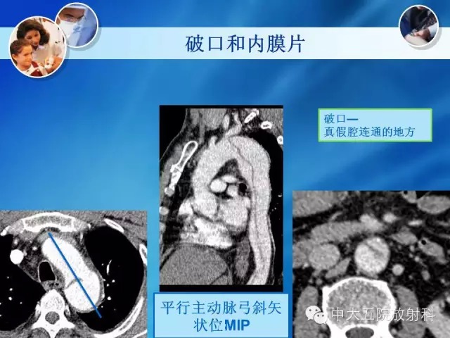 主动脉病变病理基础和影像表现