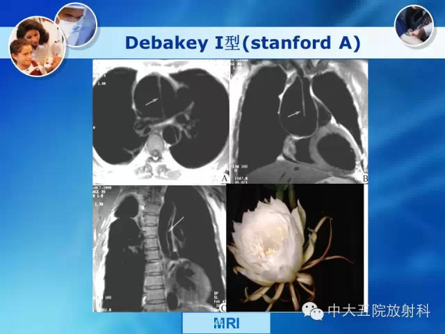 主动脉病变病理基础和影像表现