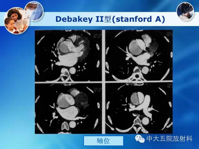 主动脉病变病理基础和影像表现