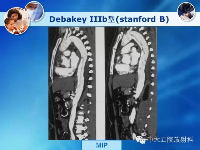 主动脉病变病理基础和影像表现