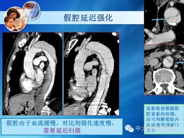 主动脉病变病理基础和影像表现